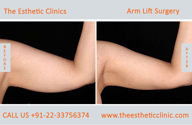 Arm Lift Surgery, Brachioplasty before after photos in mumbai india (5)